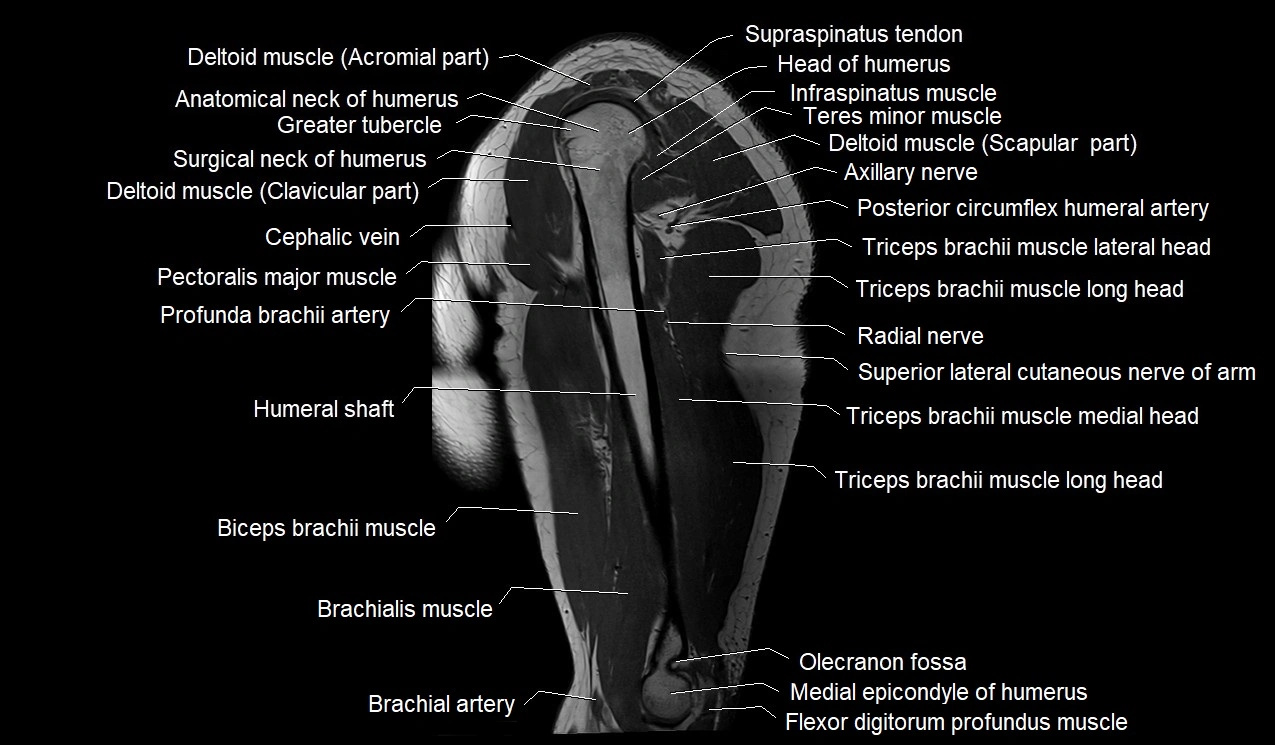 Upper arm (humerus ) saittal cross sectional anatomy 3T image 17.webp